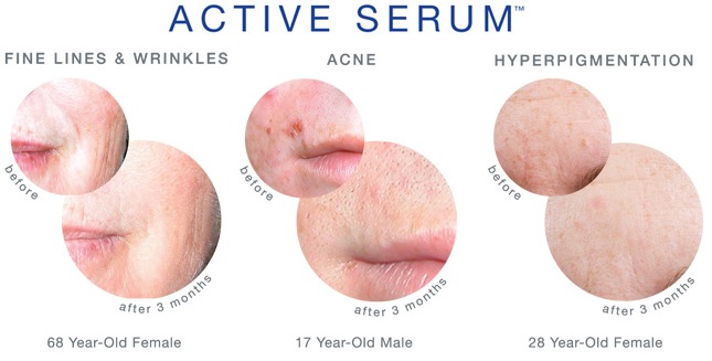 iS Clinical Active Serum Results for Acne, Wrinkles, Hyperpigmentation