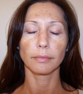 What Causes Hyperpigmentation